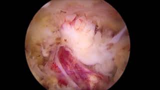 Dual portal (biportal) paraspinal approach for foraminal HNP