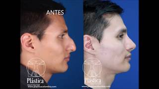 Rinoplastia - Giba nasal / Fotos reales Cirugía de nariz de antes y después /