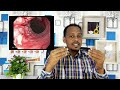 kansarka ku dhaca dhunto calamadaha lagu garto sidalagu daweyo esophageal carcinoma dr.mahamed liban