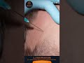 Pain-Free Hair Transplants || Expert Advice, Rootz Hair Transplant Clinic #haircare #hairtransplant