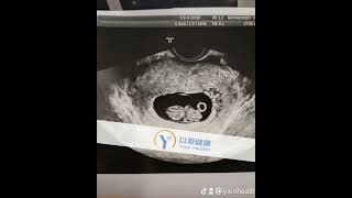 以恩健康:乌克兰代孕妈妈孕8-9周产检顺利通过！ #代孕机构 #surrogacy #代孕流程 #代孕费用 #代孕公司 #代孕流程#代孕