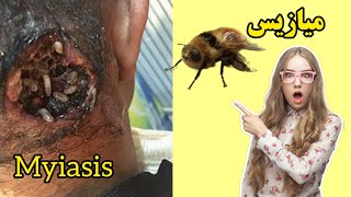 معرفی بیماری #میازیس که سبب لانه‌گزینی لارو مگس در بدن می شود. #myiasis