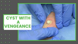 Cyst with a Vengeance | Dr. Derm