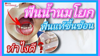 เด็กฟันน้ำนมโยก ฟันแท้ซี่แรกขึ้นซ้อน | Yu clip