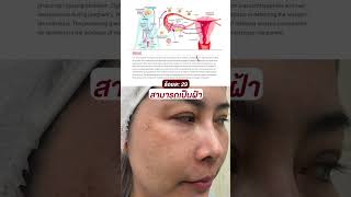 ฝ้าฮอร์โมนพยาบาลสาว หายได้ 90% ด้วยเทคนิดนี้!! l Doctornatclinic