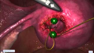 LapSim Gynecology: Myoma Suturing