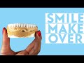 Smile Makeover / Dental Wise Turkey