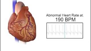 Normal Vs Accelerated Heart Rate