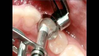 Amalgam Fillings Procedure | Lake Merritt Dental, Oakland, CA