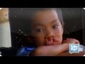 Operation Smile Provides Free Surgeries to Children⎢TakePart TV