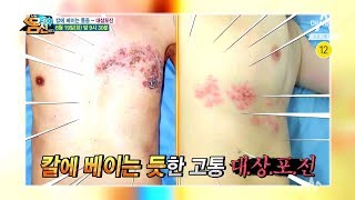 [나는 몸신이다 예고] 칼에 베이는 고통! 대상포진! 골든타임을 잡아라 / 채널A 나는 몸신이다 180회