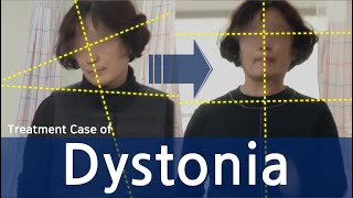 Dystonia / Cervical Dystonia / Spasmodic Torticollis / 사경증 치료 / 근긴장이상증