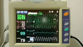 心電図モニター 実際の測定　VTACHY(心室頻拍) [NIHONKOHDEN LifeScope I]
