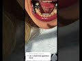 Braces appliance . Asmr