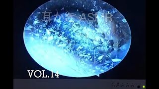 VOL.14 耳かき ASMR | Remove mountains of earwas, 耳垢を取り除く. | OMG 6 year old boy has Otolith