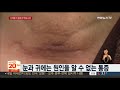 신제품 지혈제 부작용 논란…갑상선 환자 31명 재수술 연합뉴스tv yonhapnewstv