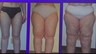 Lipedema: Women gaining weight at no fault of their own