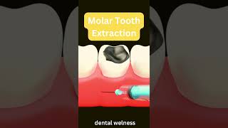 Tooth Extraction