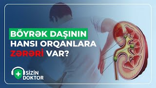 BÖYRƏK DAŞINI YARADAN QİDALAR - SİZİN DOKTOR - (04.09.2023)