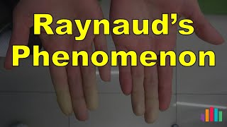 Raynaud's Phenomenon