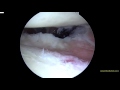 Right Shoulder arthroscopic capsular release for frozen shoulder DN63016