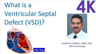 What is a Ventricular Septal Defect (VSD)?
