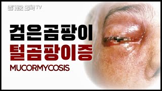 검은곰팡이증(털곰팡이증) 때문에 안구적출까지 해야 한다구요? Mucormycosis [feat. 할로우 죽음의 제물]