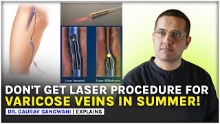 Best time to get varicose veins operated | Varicose veins treatment | Dr. Gaurav Gangwani