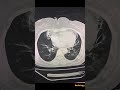 Asthma - CT Chest |Radiology| #asthma #chest #ctscan