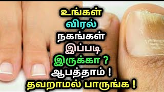 உங்கள் விரல் நகங்கள் இப்படி இருக்கா ? ஆபத்தாம் ! தவறாமல் பாருங்க ! Nail fungus | Health tips