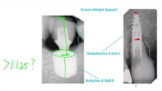 CEREC TiBase Lecture Series Lesson 03