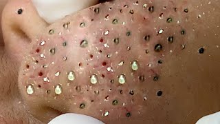 blackhead pimples removal of the elderly