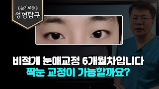 Q. 비절개눈매교정 6개월차입니다 짝눈 교정이 가능할까요?