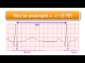 ECG basics 10/10 - The QT Interval