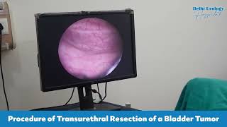 Transurethral Resection of Bladder Tumor | Procedure | Delhi Urology Hospital