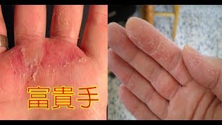 碰水發癢、富貴手好不了？「六招護手法寶」：杜絕手皮龜裂、紅腫痛，一個月有感