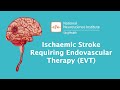 Understanding Stroke: Treating Stroke with Endovascular Therapy (EVT)