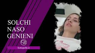 Filler Rughe Naso Labiali, Solchi Naso Genieni | Sottopelle.it