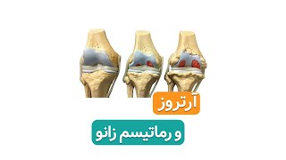 تفاوت آرتروز و رماتیسم زانو ( دکتر محمدرضا صادقی _ جراح ارتوپد تهران )