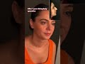 After 1 Year Rhinoplasty Operation in Turkey | Op.Dr.Harun Acıpayam