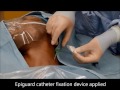 usg interscalene catheter insertion pajunk e cath out of plane technique