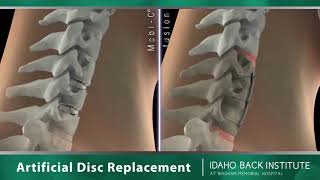 Idaho Back Institute Artificial Disk Replacement