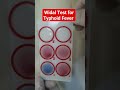 Widal Test for Typhoid and Paratyphoid Fever | Salmonella Agglutination Test