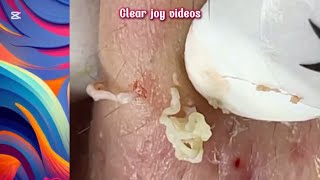 Big Cystic Acne Blackheads Extraction Blackheads \u0026 Milia, Whiteheads Removal Pimple Popping