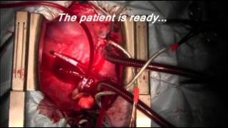 Heart transplantation