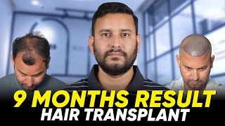 Hair Transplant in Istanbul | Best Results \u0026 Cost of Hair Transplant in Istanbul