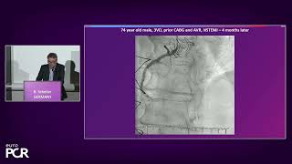 Complex coronary artery disease: can stents and DCB be complementary? - EuroPCR 2023