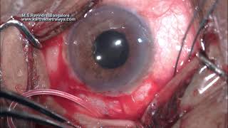 AADI Glaucoma shunt; New \