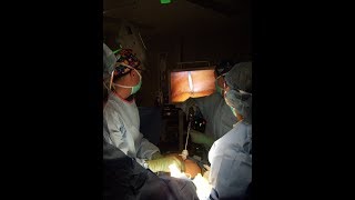 The Wonders of Laparoscopic Camera Surgery