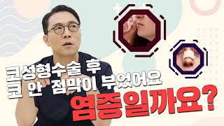 170화.  코성형수술 후  숨쉬기가 힘들어요ㅠㅠ